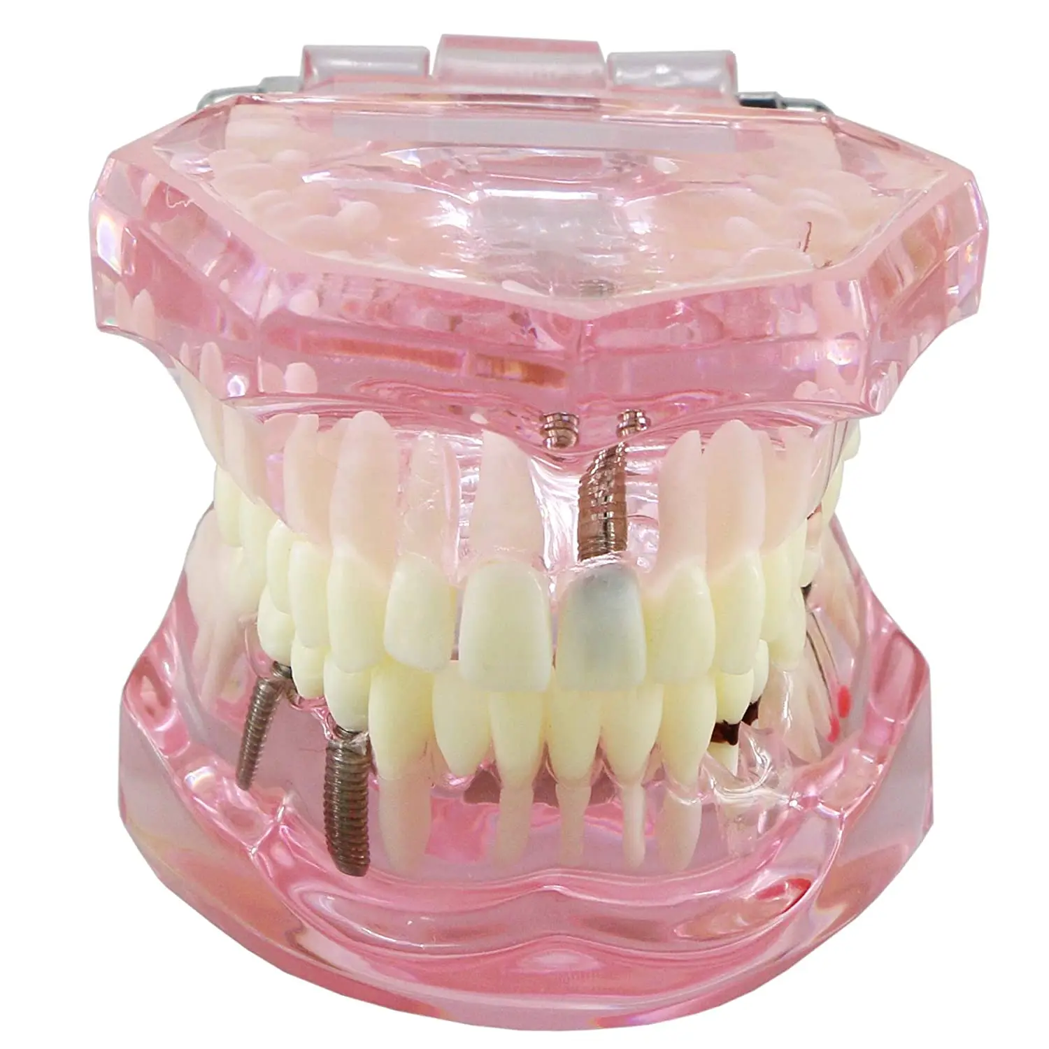 Transparent Dental Implant Disease Pink Clear  Removable Teeth Model Student Teaching