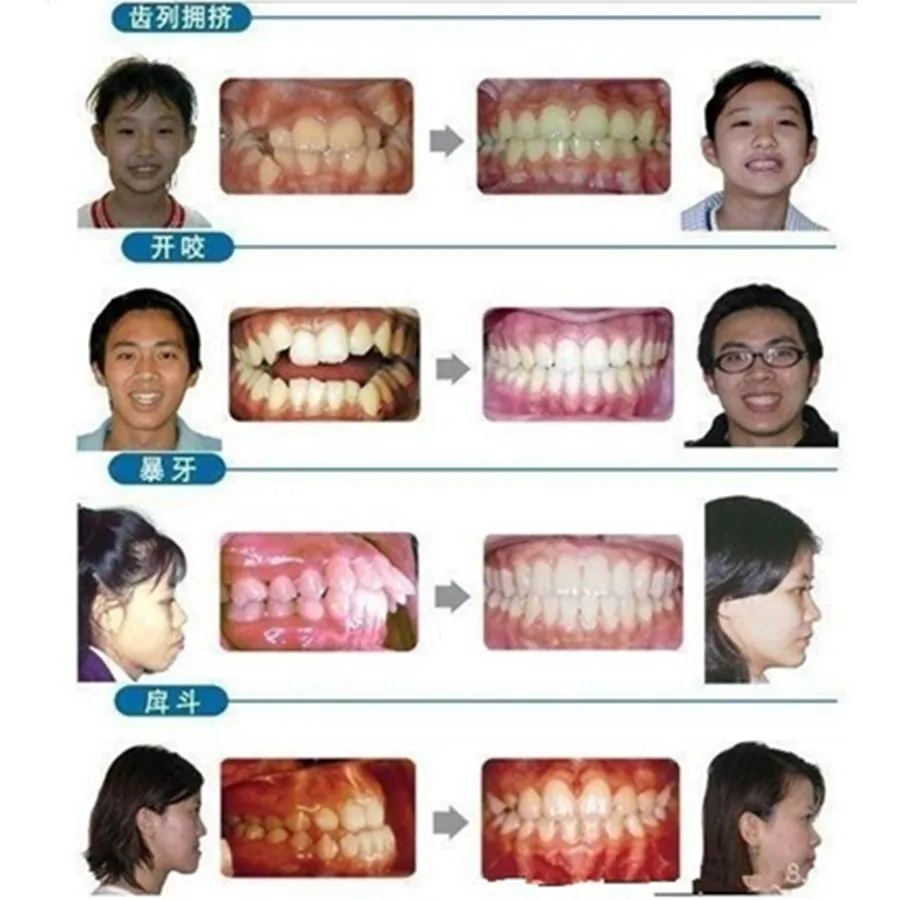 Брекеты для зубная Ортодонтическая полости рта во второй стадии фиксатор зубной