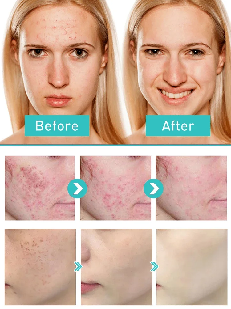 Салициловая кислота крем для лечения прыщей гель восстановления против