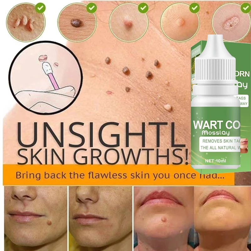 

2022 New Skin Tag Remover Cream Painless Mole Skin Dark Spot Warts Remover Serum Freckle Face Wart Tag Removal Treatment Skin