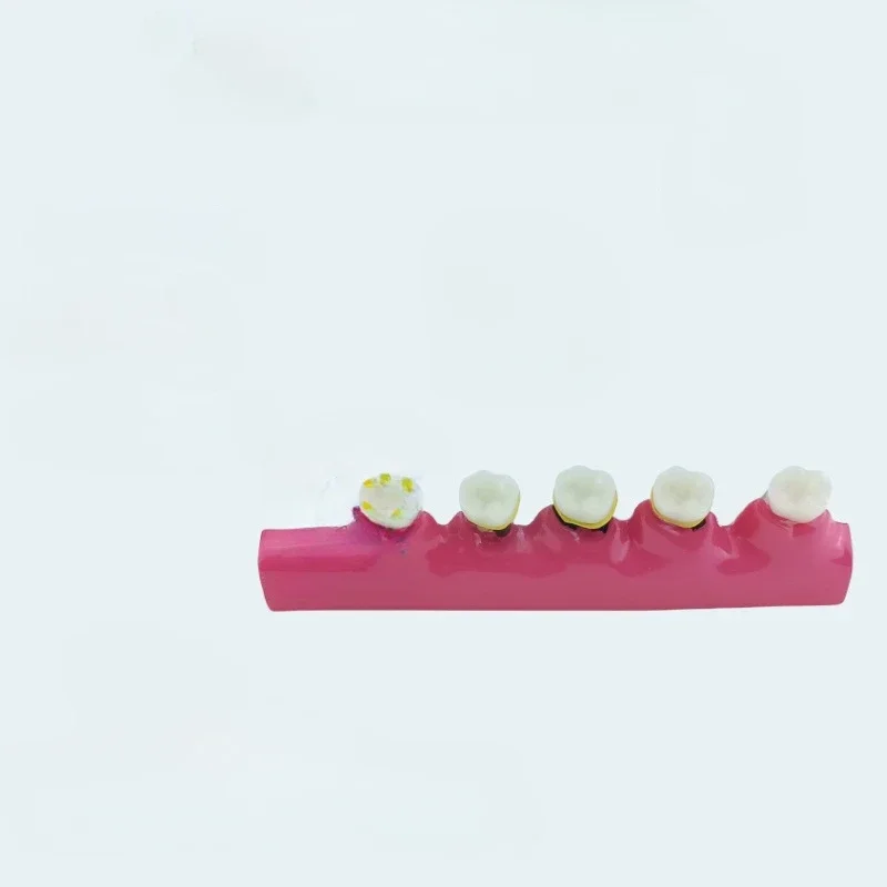 Модель пародонтита смола модель пародонтальной эволюции для взрослых