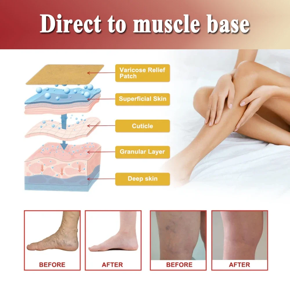 Улучшенные пластыри от варикозного расширения вен Jemeesen для улучшения