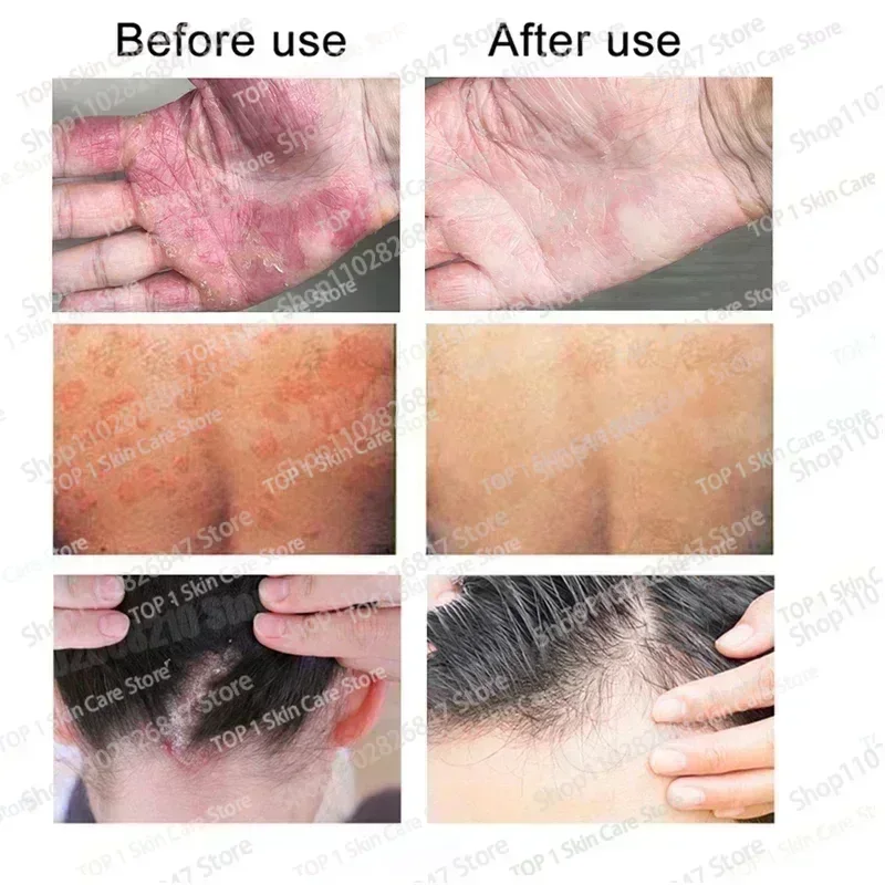 Увлажняющий крем от псориаза естественный ремонт эффективно антибактериальный