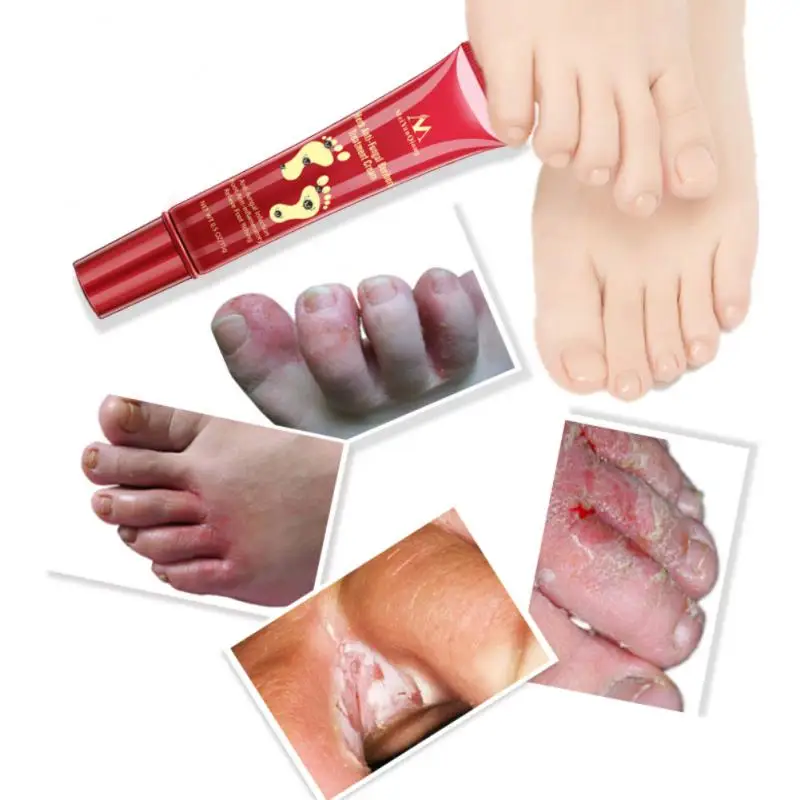 

MeiYanQiong травяной противогрибковый крем для ног берберики уход за кожей лечение ног противогрибковая инфекция ремонт ног новый продукт