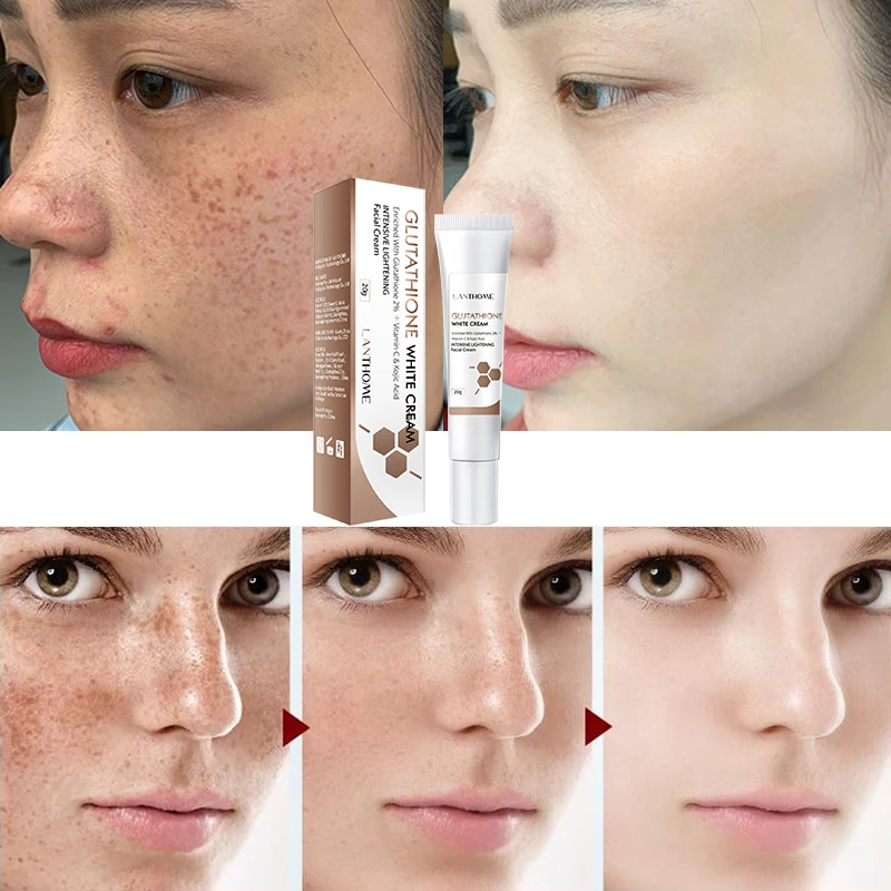 

Effective Whitening Freckles Cream Remove Melasma Dark Spot Fade Melanin Anti-Pigmentation Improve Dullness Fast Brighten Skin