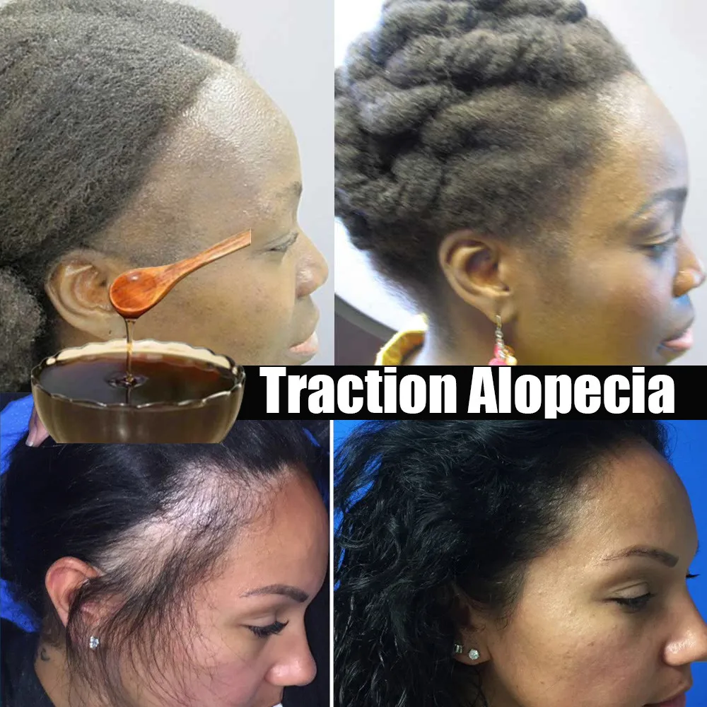 

Африканский женский экстракт для лечения алопеции продукт для роста волос для мужчин имбирный шампунь против выпадения волос лечение от париков