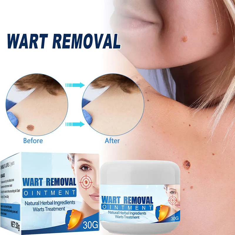 

Wart Remover Cream Easy Effective Wart Treatment Cream Remove Common Skin Tag For Women Men PR Sale