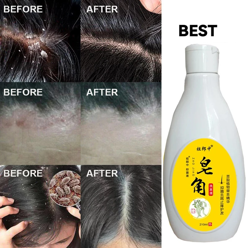

Saponin Shampoo Dandruff Removal Oil Control Scalp Itching Antibacterial Seborrheic Dermatitis Cleansing Scalp Shampoo