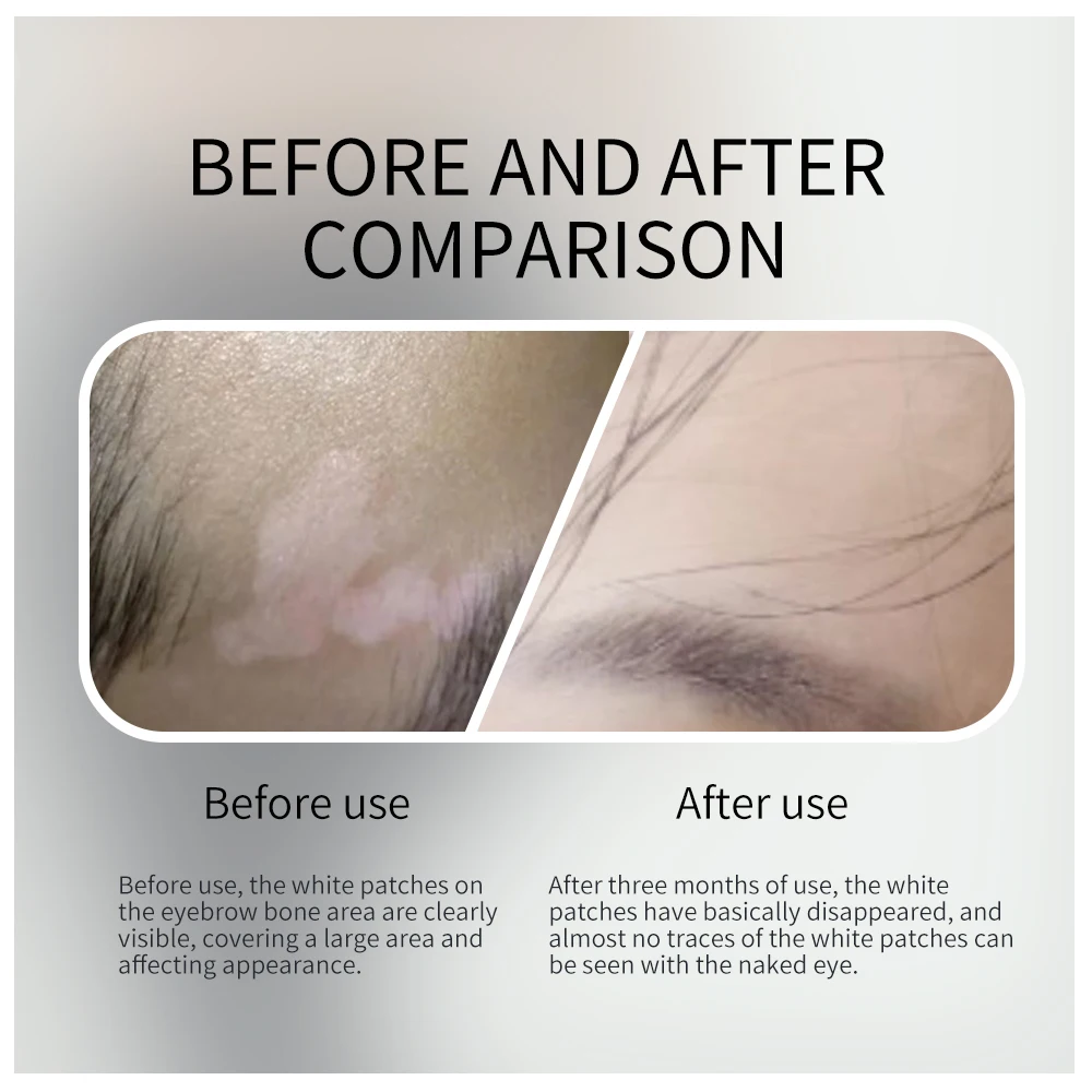 308-нм УФ-эксимерный светотерапевтический аппарат XeCl Лампа с бесплатной