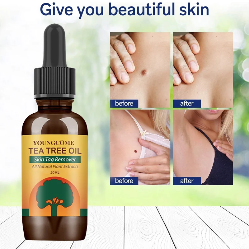 

20ml Organic Skin Tags Solutions Serum Painless Mole Skin Dark Spot Warts Remover Freckle Face Wart Tag Removal Essential Oil