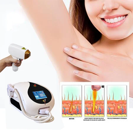 

wavelengths 810 diode ice alma titanium trio laser 755/808/1064nm hair removal medical Skin Beauty Equipment