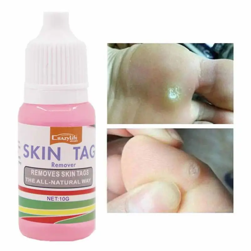 

Средство от бородавок, бородавок и бородавок