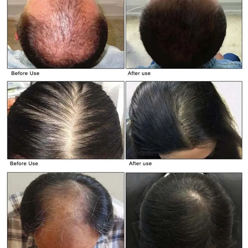 

Сыворотка для быстрого роста волос, сыворотка для роста волос с розмарином, масло для роста волос, против выпадения волос, восстанавливает поврежденное масло, облысение, продукты для ухода за кожей головы