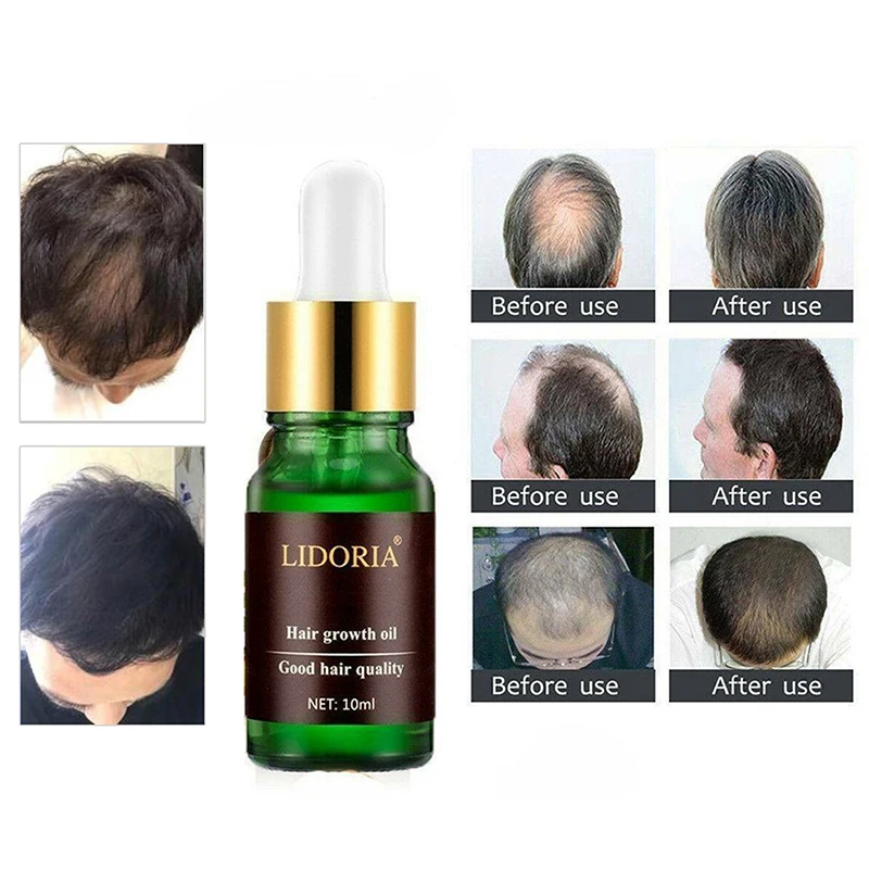 

10ml LIDORIA Powerful Hair Growth Essential Oil Hair Loss Nourishing Treatment