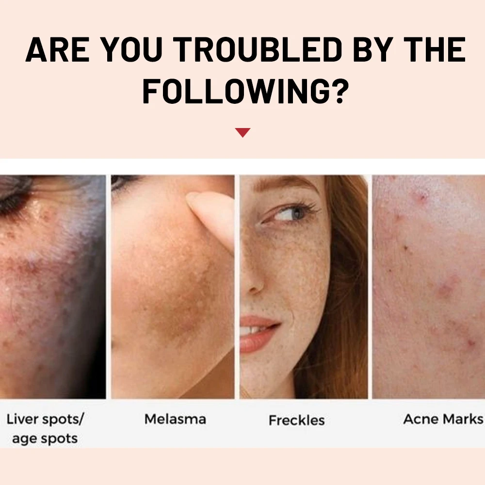 Отбеливающий и крем против веснушек удаляет темные пятна солнечные