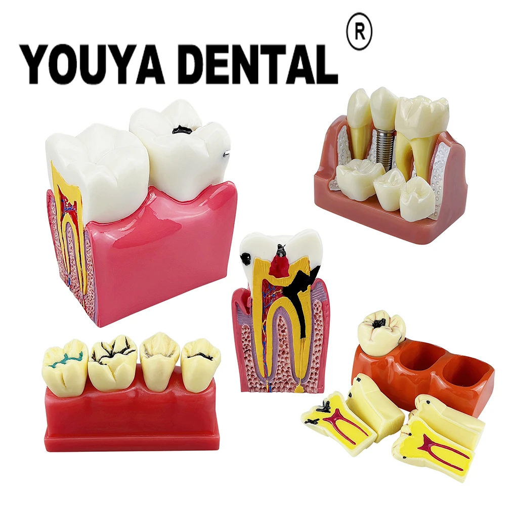 

Teeth Dental Studying Teaching Models Teeth Implant Model for Dentist Technician Student Practice Training Oral Medical Model