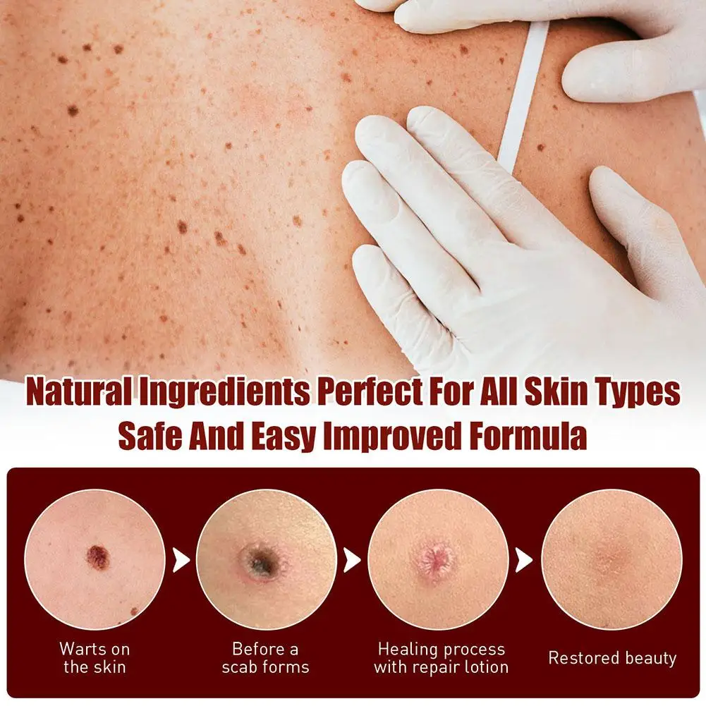 Рисунок 4 - жидкая ручка для удаления мозолей и бородавок