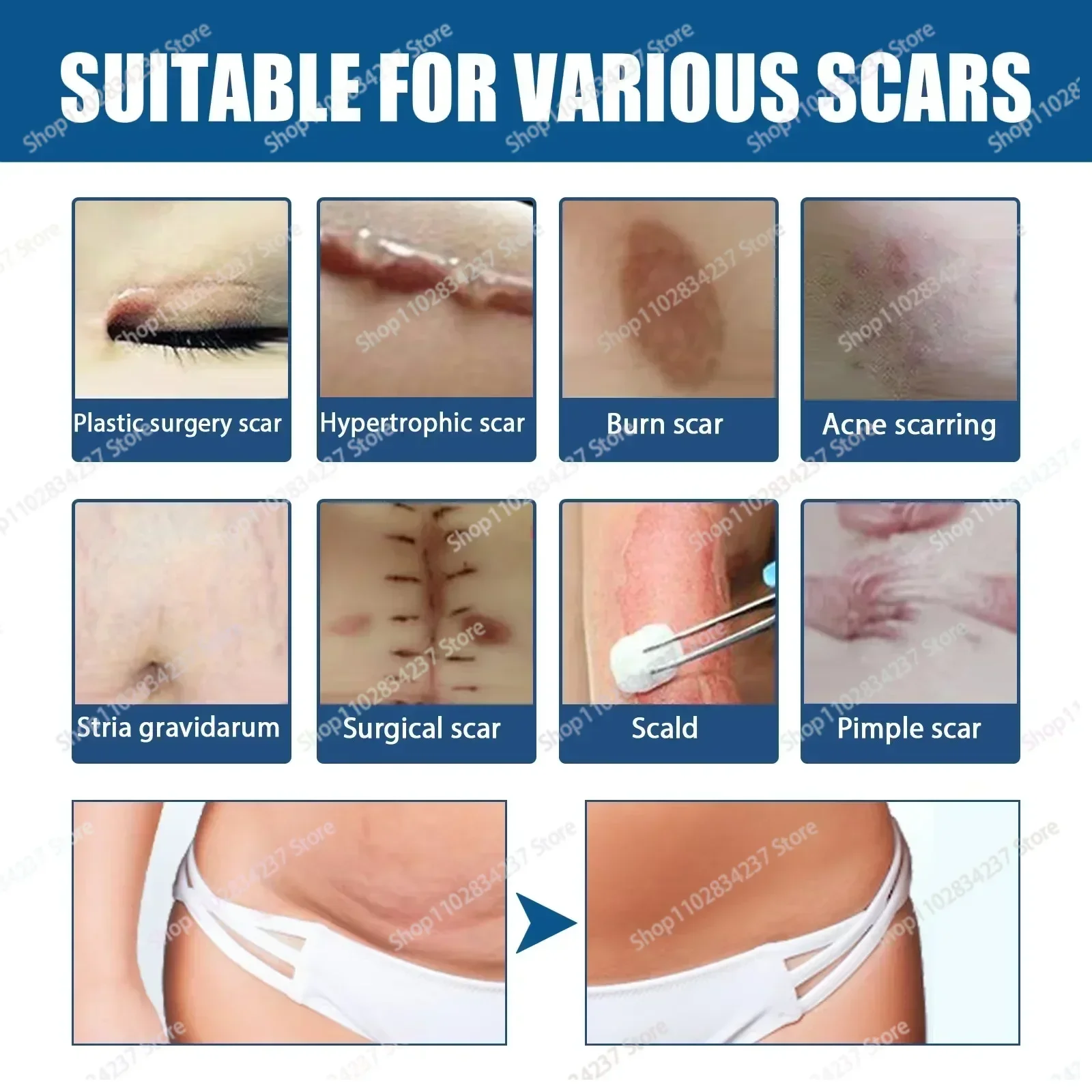 ГОРЯЧАЯ ПРОДАЖА восстанавливающий крем для удаления шрамов от прыщей растяжек