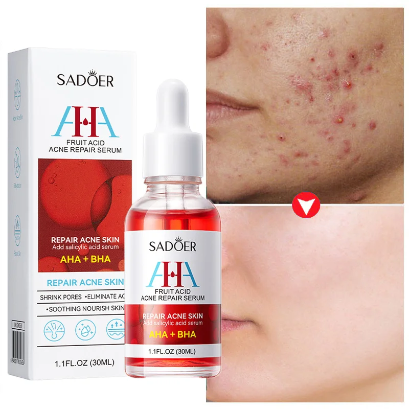 Fruit Acid Acne Mark Scar Remove Face Serum Pore Shrinking Blackheads Spot Treat Essence Moisturizing Brighten Skincare Product