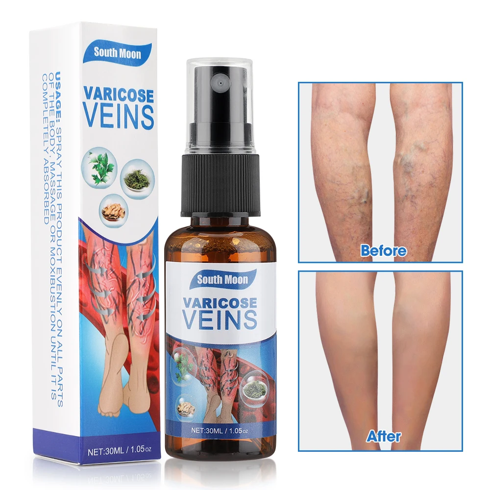 

30ml Varicose Vein Soothing Spray Veins Treatment Spray On Leg Acid Bilges Itching Earthworm Lumps Bad Leg Cure Natural Solution