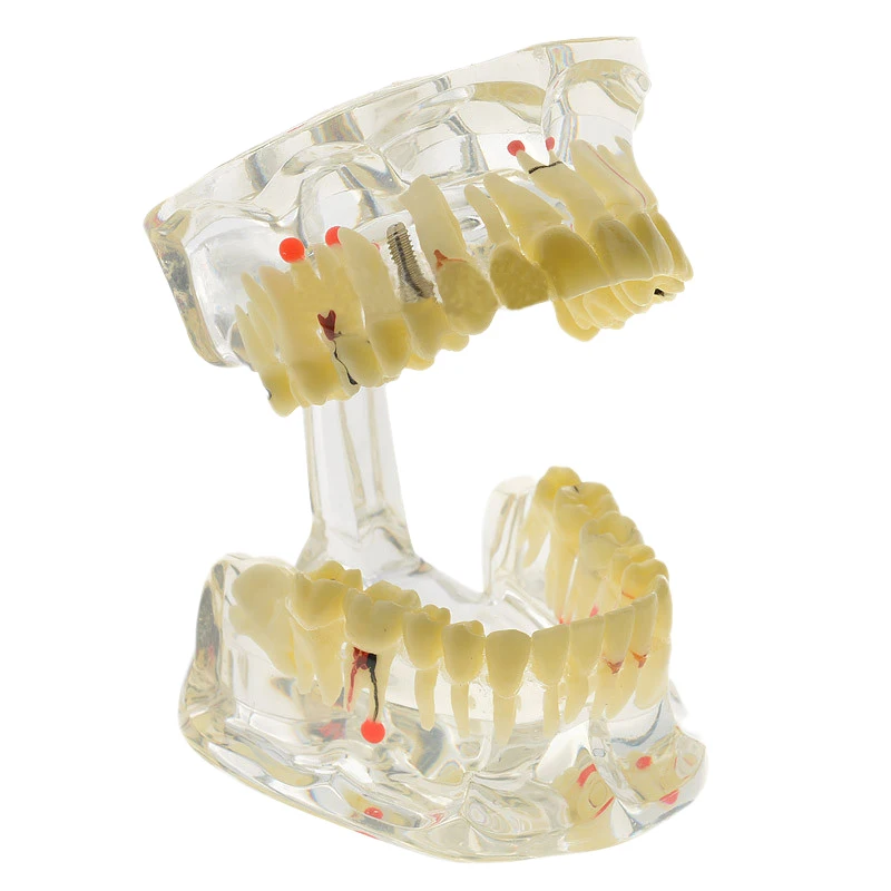 

Implant Disease Teeth Model With Restoration Bridge Dentist For Science Disease Teaching Study