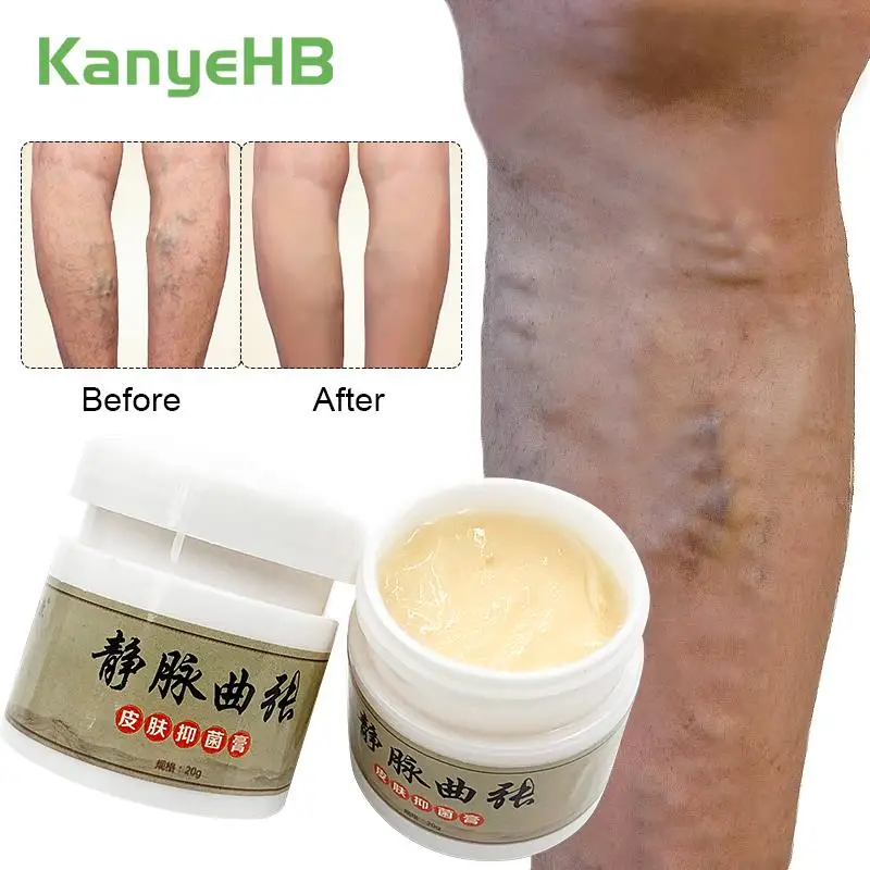 

2Pcs Effective Varicose Vein Relieve Cream For Varicocele Relieve Vasculitis Phlebitis Vein Pain Swell Treatment Ointment A1247