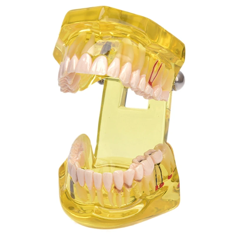 

Implant Disease Teeth Model With Restoration Bridge Tooth Dentist For Disease Teaching Study