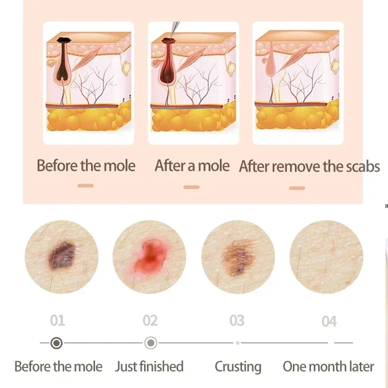 Теги для удаления кожи Лазерная плазменная ручка Машина родинок Пикосекундные