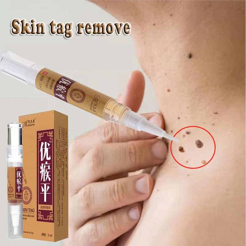 

Skin Care Skin Tag Remover Medical Against Moles Removal Genital Wart Acne Spot Treatment Anti Foot Corn Liquid Removal Warts