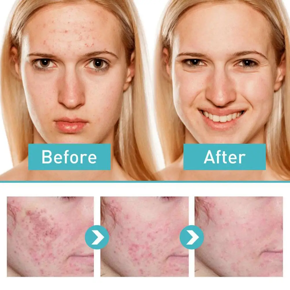 Крем для удаления веснушек 50 г корректор темных точек осветление пигментации