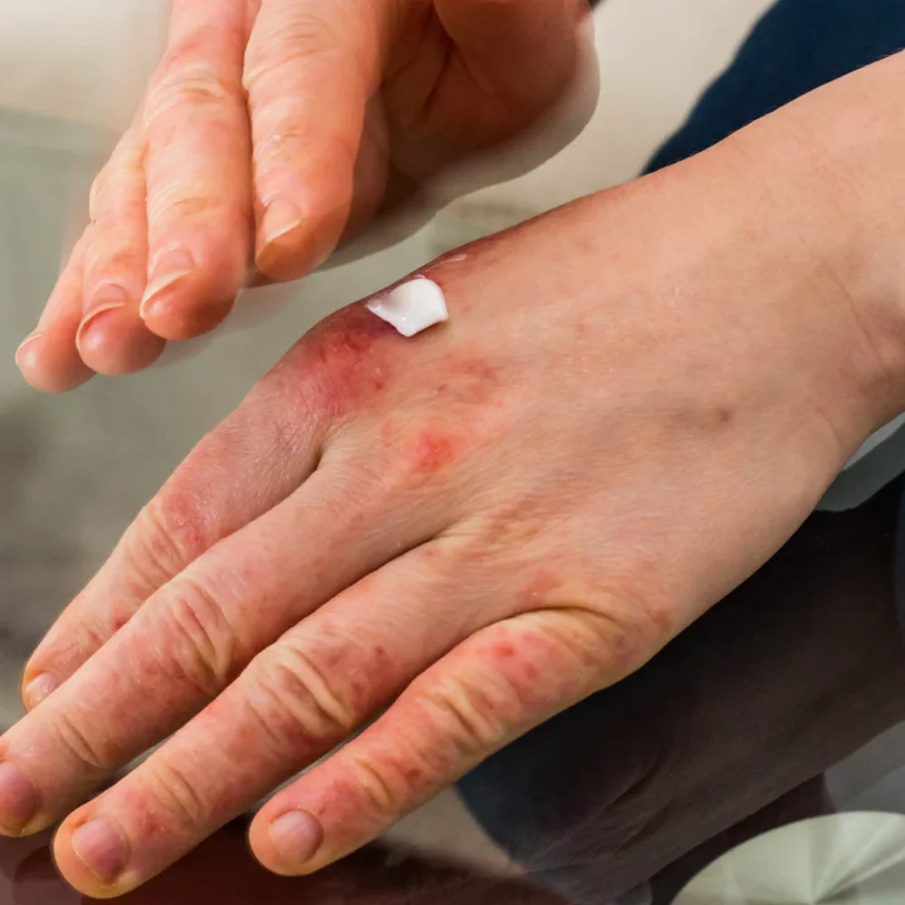 1/3/5/10/20 шт. крем для лечения герпеса пота снимает сверх кожи антибактериальная