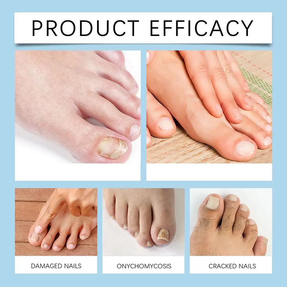 ł na grzybicę paznokci Serum do usuwania grzybów Przeciw infekcjom Paronychia Onychomycosis Paznokcie stóp Produkty pielęgnacji 30 мл