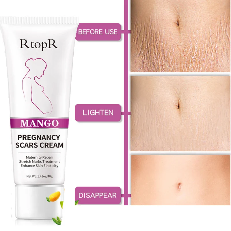 

Body Creams Remove Pregnancy Scars Acne Cream Stretch Marks Treatment Maternity Repair Anti-Aging Anti-Winkles Firming Skin Care