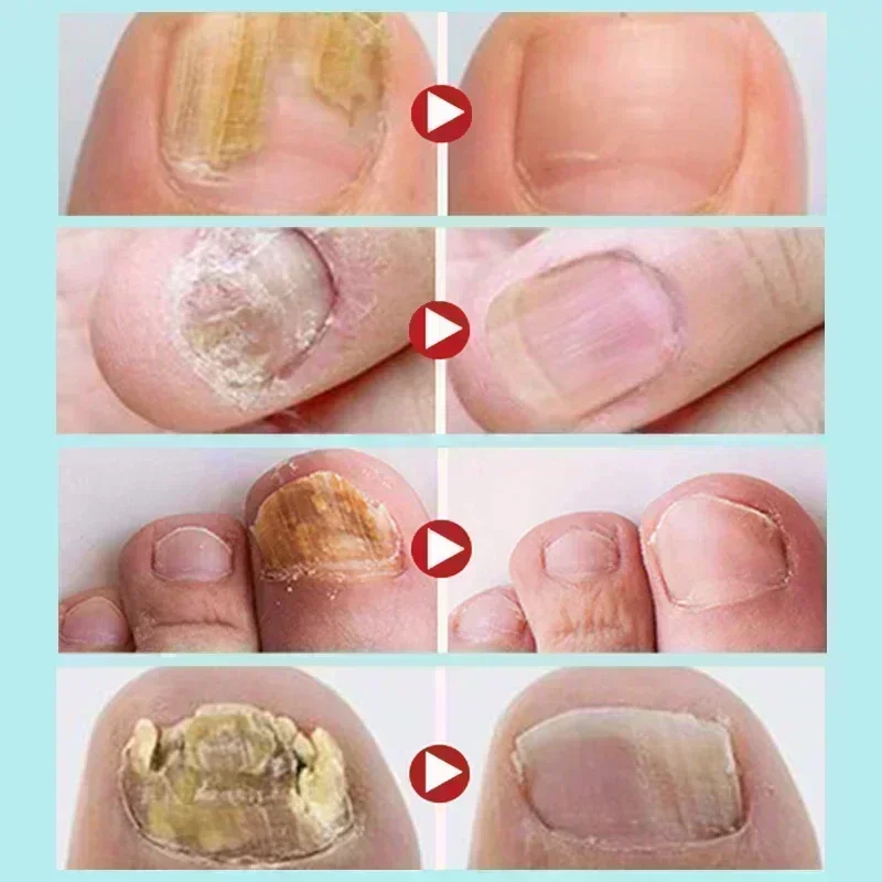 Новое лечение грибка ногтей для силового восстановления на ногах увлажняет
