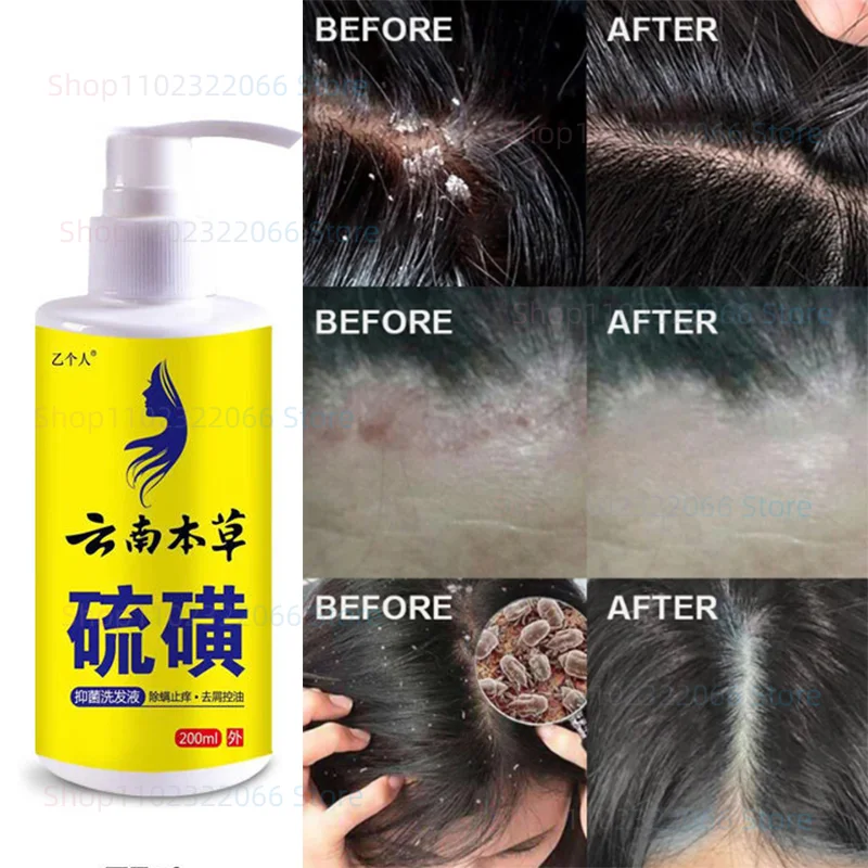 Hair Follicles Yan Keloid Scalp Tinea Dandruff Dermatode Dermatode Oil Control Anti Itching Sulfur Shampoo