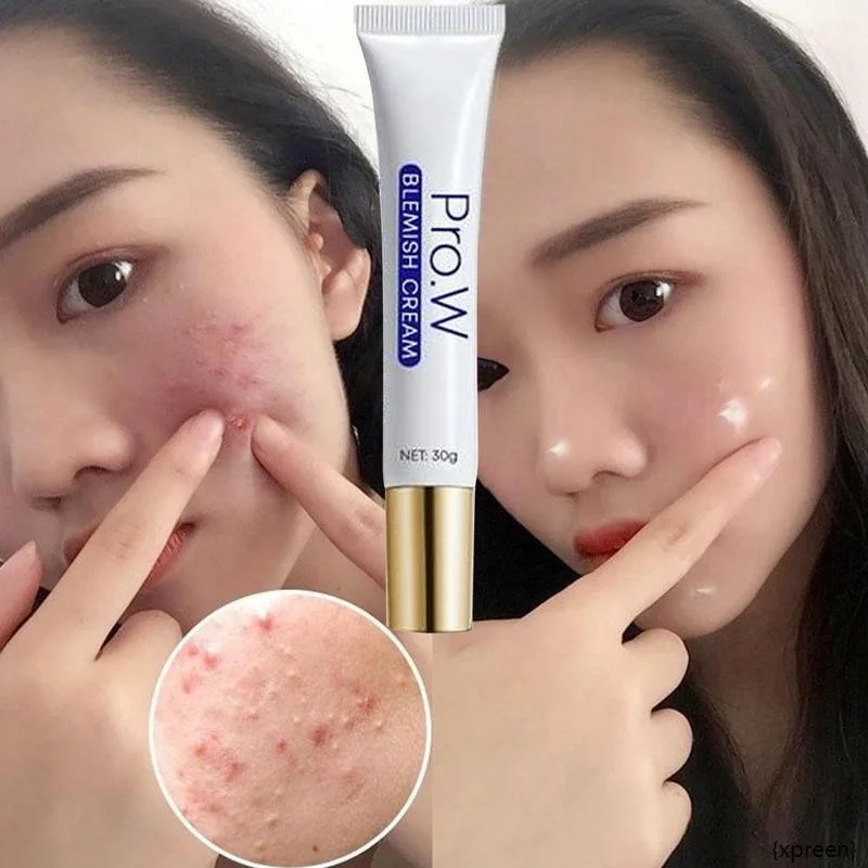 30ml Pro.W Blemish Cream Freckles Acne Pimple Scar Dark Spots Removal Skin Whitening Brightening Face Cream