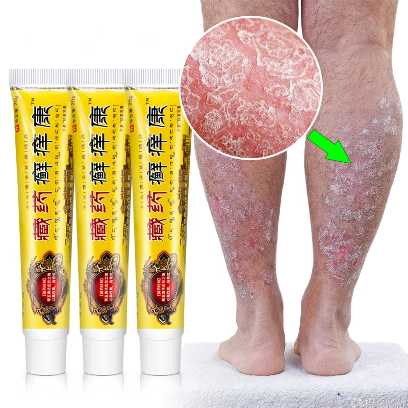 

20g 3pcs Psoriasis Ointment Beriberi Treatment Cream Inhibit Fungi Skin Cream Anti-itch Rash Dermatitis Eczema Medical Plaster