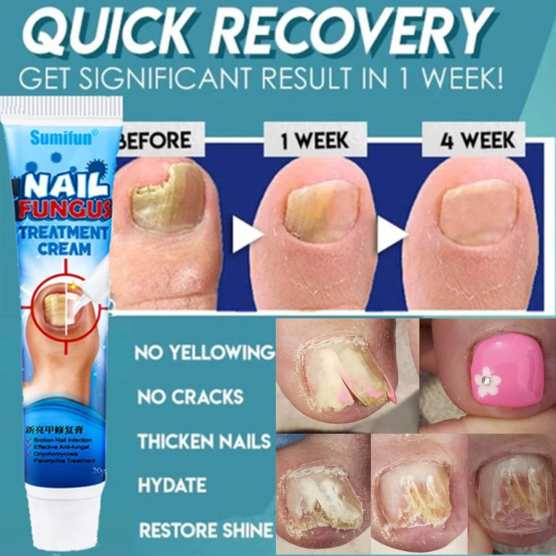 

20g Nail Fungus Removal Cream Ointment Remove Onychomycosis Fungus Paronychia Promote Nail Growth Anti Infection Feet Care
