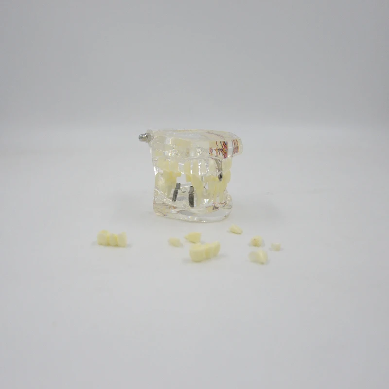 Имплантат съемный с нейроральной стоматологической моделью, анатомическая модель человеческих зубов, обучающее оборудование, медицинский инструмент, Обучающие ресурсы Имплантат съемный с нейроральной стоматологической моделью, анатомическая модель человеческих зубов, обучающее оборудование, медицинский инструмент, Обучающие ресурсы