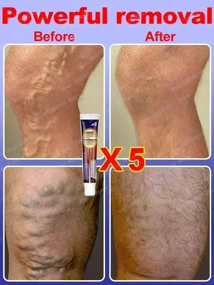 Крем для удаления варикозного расширения вен мазь ухода за телом крем лечения