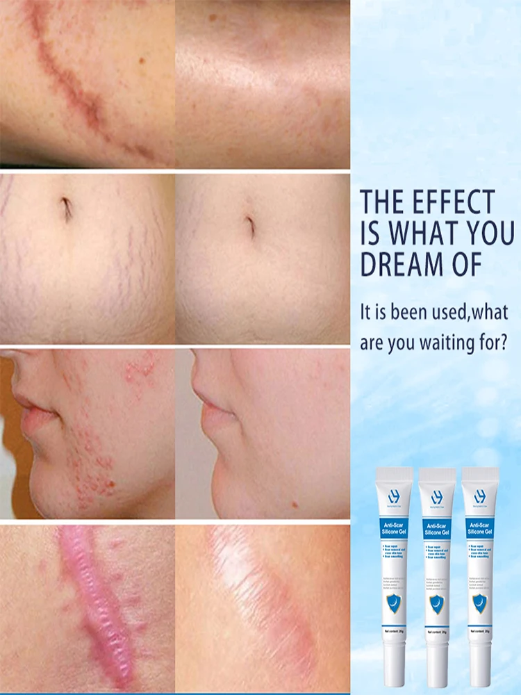 Келоидный крем