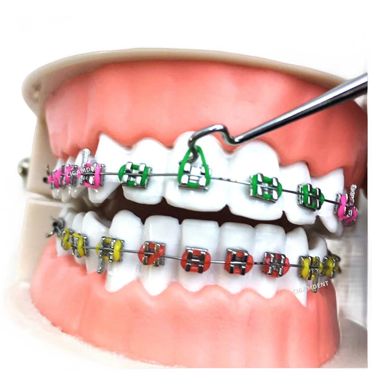 брекеты roth. 018. брекеты дэймон q. лигатурные брекеты biomim. безлигатурные брекеты damon.