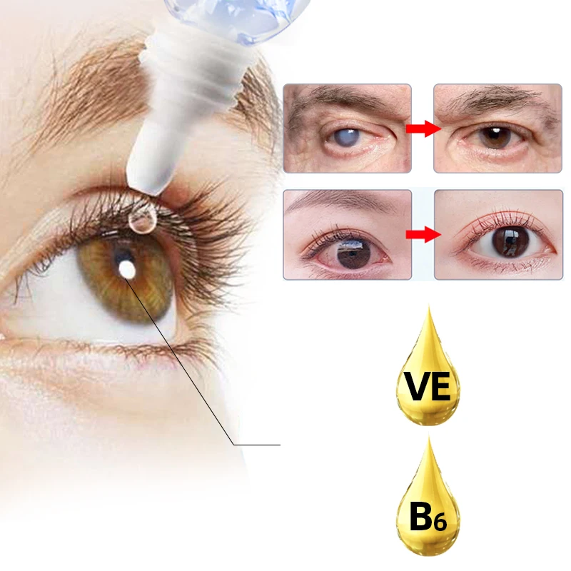 Cataract Treatment Medical Eye Drops Cfda Approve Apply To Blurred Vision Cloudy Eyeball Black Overlapping Shadow Vitamin B6 E |