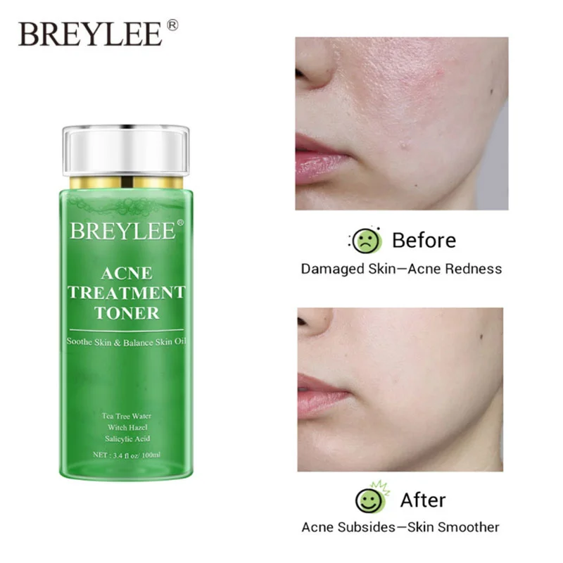 

BREYLEE Acne Treatment Toner Oil Control Moisturizing Pimple Removal Shrink Pores Soothing Acne Whiten Tea Tree Face Serum 100ml