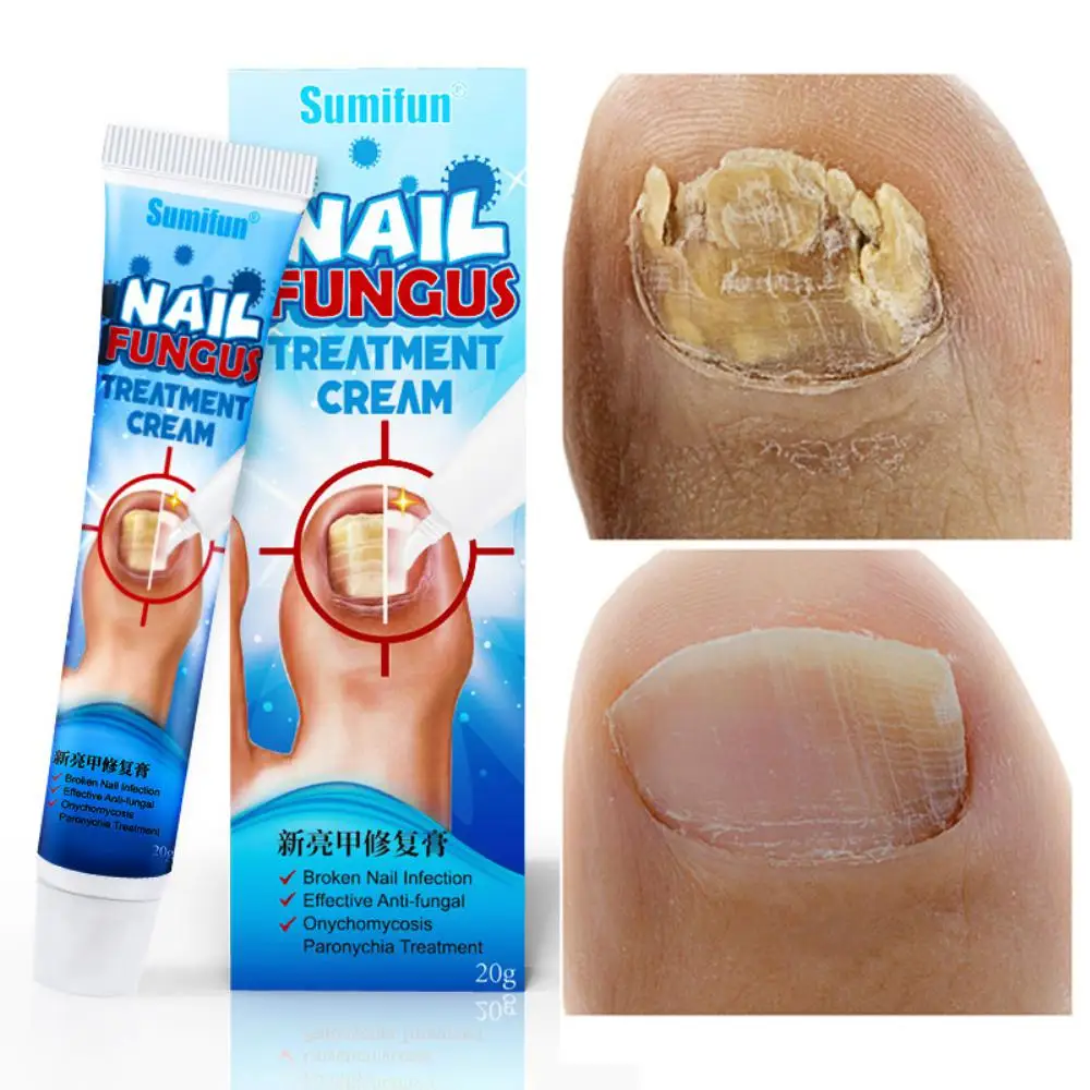 

Nail Repair Onychomycosis Nail Nail Cream Nail Removal Cream Nail Groove Toe Nail Care Ointment Nail Care