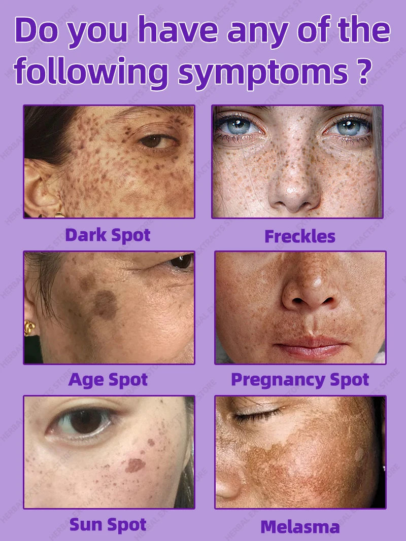 Clear Sun Dark Age Spot Веснушки Хлоазма