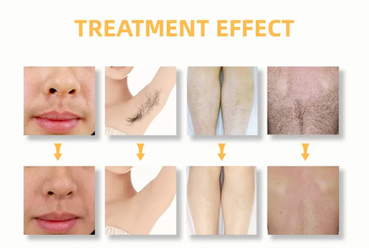 Уникальная запатентованная дезинфекционная sterllization755 нм 808 1064 диодный лазер для