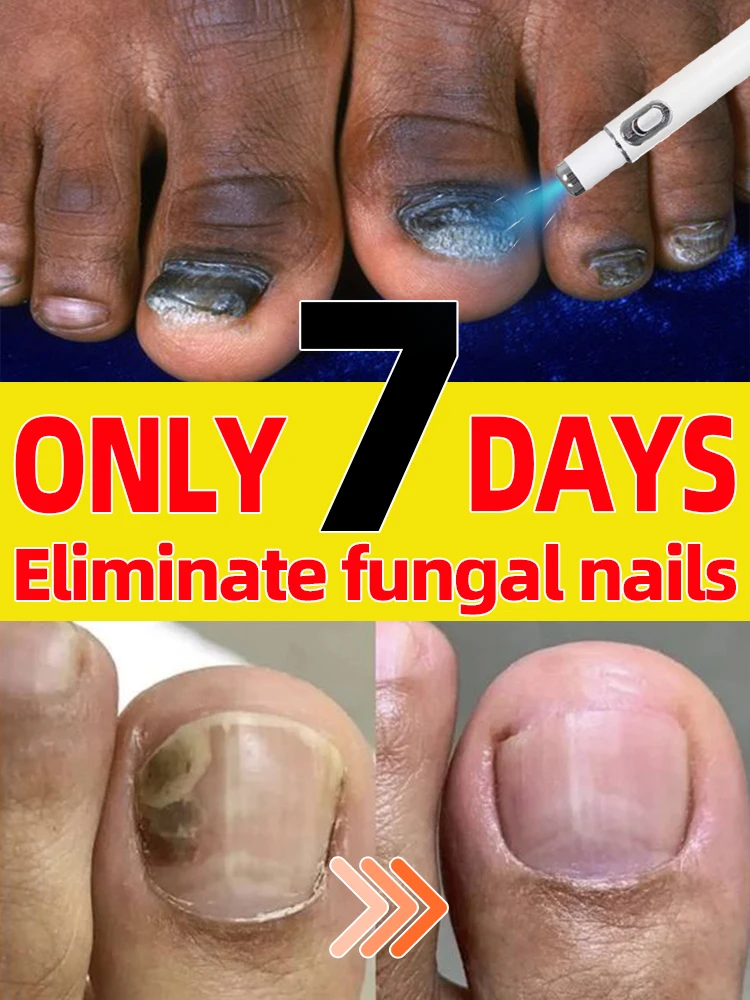 Лазерный продукт для решения проблем с гвоздями