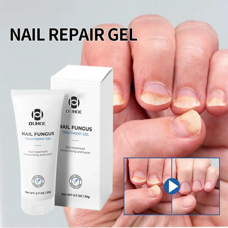 

Уход за ногтями гель для рук и ног онихомикоз мягкий утолщение ногтей осветление ногтей ремонт ногтей гель обработка ногтей Уход за ногтями