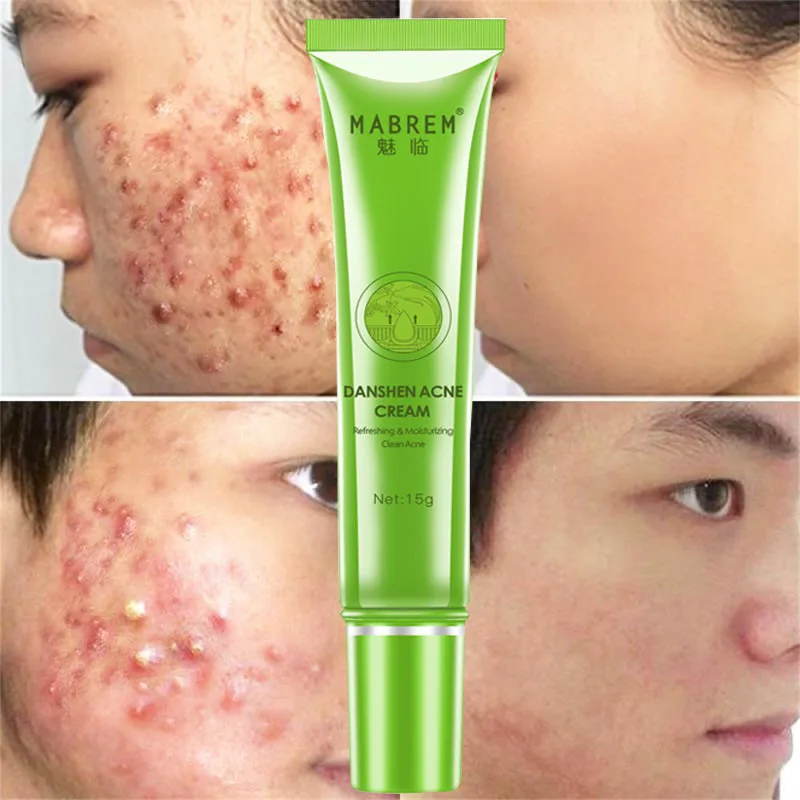 

Danshen Acne Scar Removal Cream Anti Acne Treatment Fade Spots Pimples Oil Control Cleansing Pores Moisturizing Whitening Cream